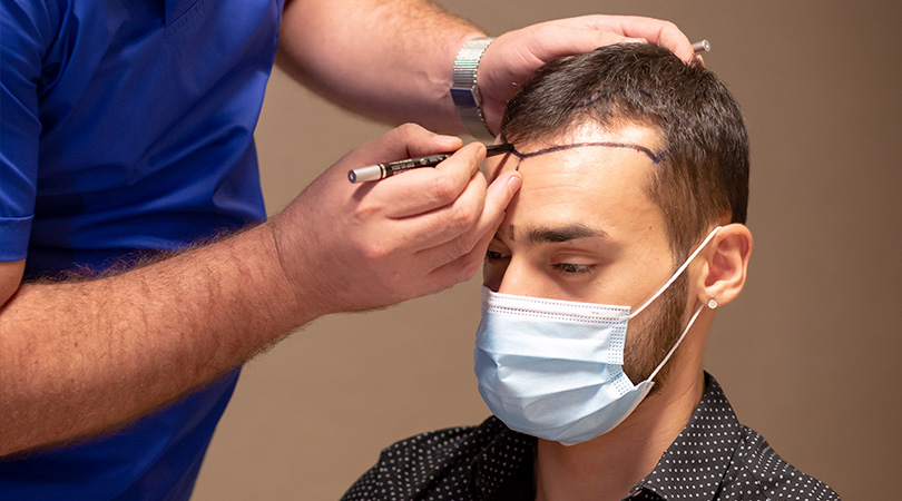 Vor dem Haartransplantationsverfahren