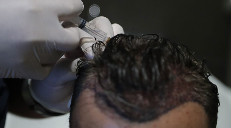 Hair Mesotherapy