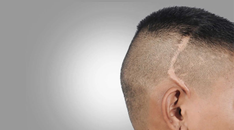 Scars Hair Transplantation