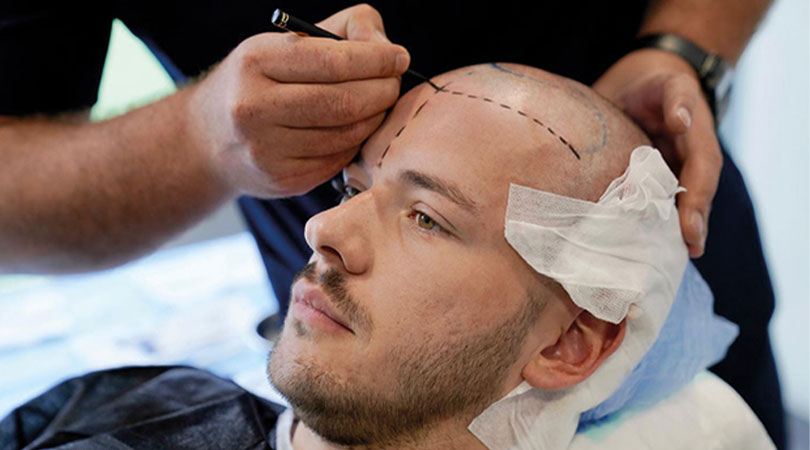 How long does it take scars of hair transplant to heal?