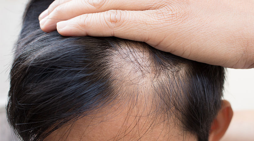 ¿Cuándo Se Debe Afeitar El Cabello Después Del Trasplante De Cabello?