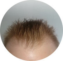 Hair Transplant Operation Step