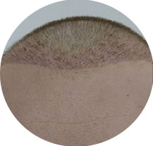 Hair Transplant Operation Step