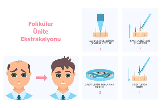 Stages of Sapphire FUE Hair Transplantation