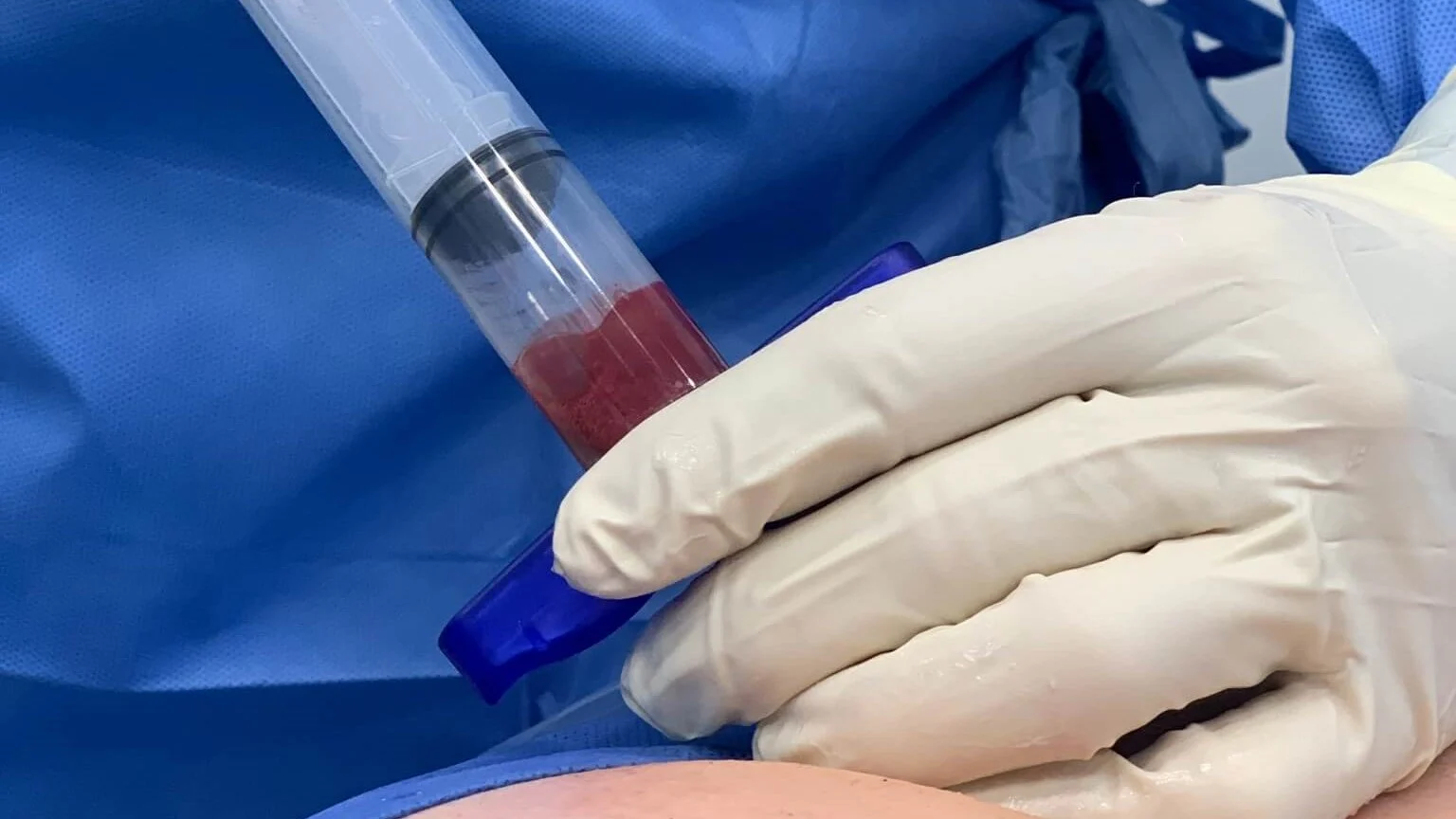 Kök Hücre Saç Tedavisi