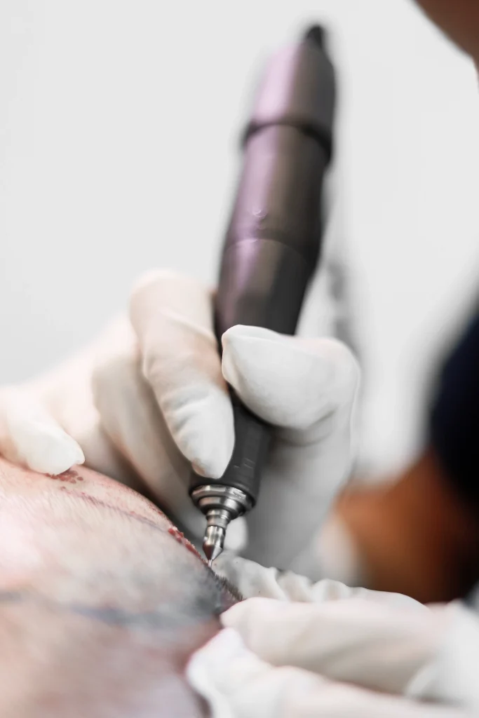 türkiyede fue saç ekimi